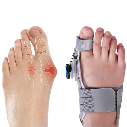Hallux Valgus-korrigerer Tåskiller Justerbar Ortotisk Tåjustering Høst 2026 Komfort og Smertelindring